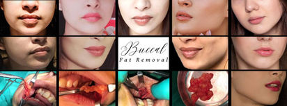 A collage of an attractive face, before and after a buccal fat removal plastic surgery