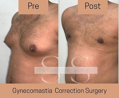 Before and after gynecomastia correction in a young man with prominent glandular tissue, fatty fullness, and excess skin