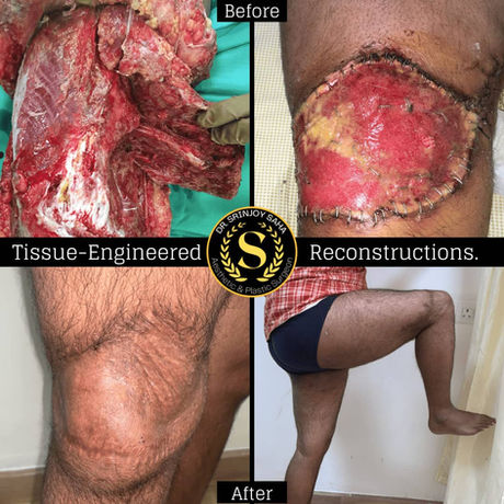 Tissue Engineered Reconstruction of Lower Extremity in a Badly Injured Lower Limb. Muscle and tendon injuries over the knee area occurred after a devastating road accident.