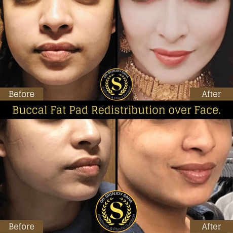 Buccal Fat Pad Redistribution Surgery in a Young Attractive Female