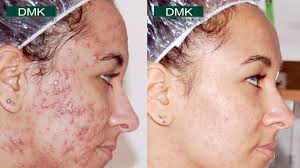 acne4.jpeg