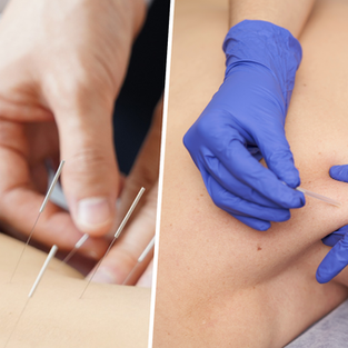 Acupuncture vs Dry Needling: Key Differences and Which One You Need