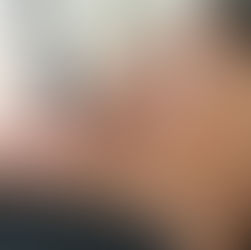 Cupping Therapy for Muscle Recovery: Benefits You Should Know