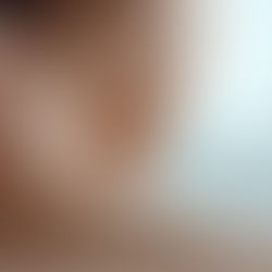 Acupuncture for Migraine Relief: What Science Says