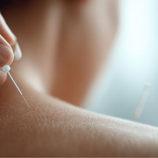 Acupuncture for Migraine Relief: What Science Says