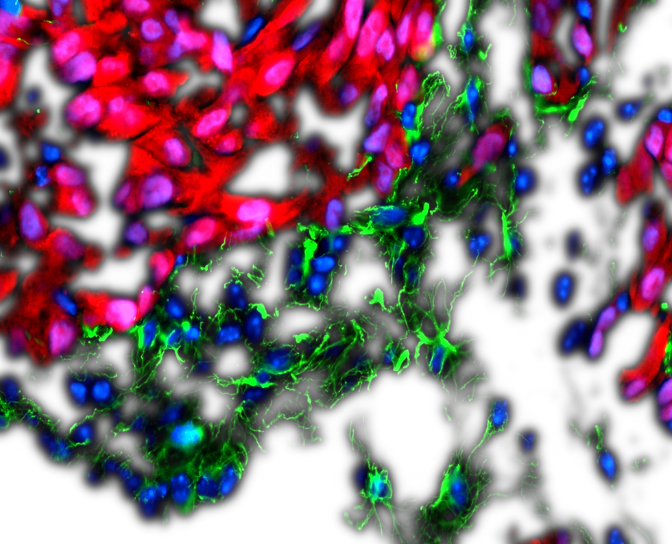 Cancer Microenvironment