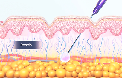 ฉีด-Collagen-Biostimulator.png