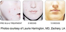 acne treatment, non prescription acne treatment, blue light therapy, blue light photodynamic therapy