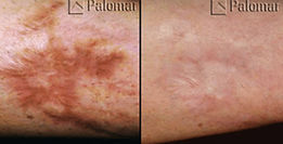 laser skin resurfacing, skin resurfacing, red deer