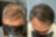 Hair density Scalp Micropigmentation before and after treatment in Surrey