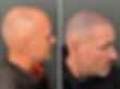 Natural looking Scalp Micropigmentation results before and after in Surrey