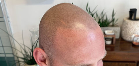 SMP - Soft Broken Hairline + Stylish Scar