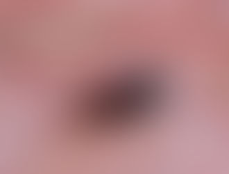 Tratamientos en palmeras. Picudo rojo