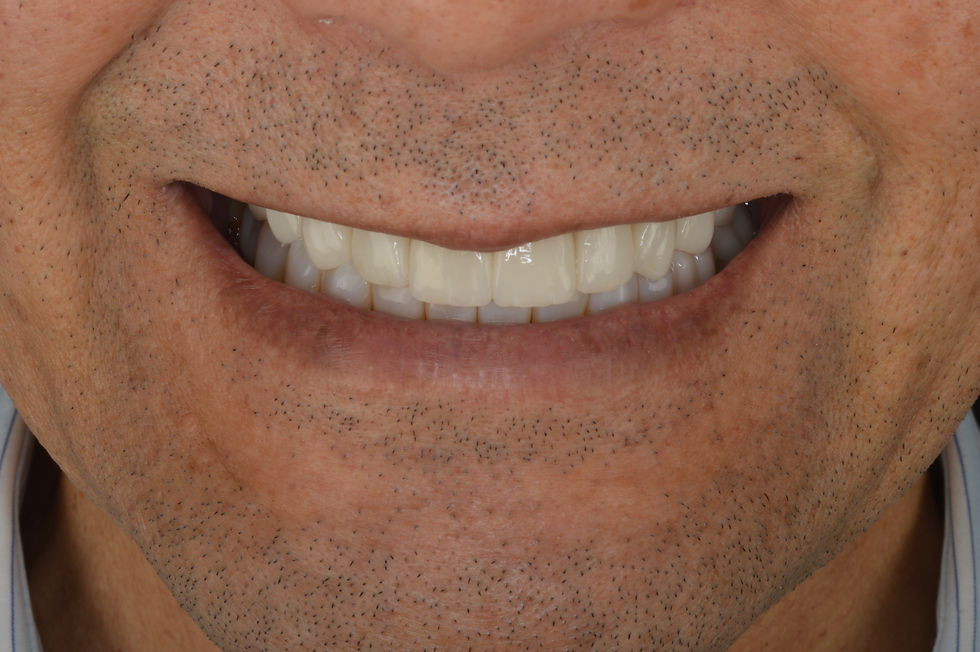 Resultado final en sonrisa tras rehabilitación oral completa en paciente con maloclusión Clase III, donde se ha conseguido una correcta integración entre estética dental, función y armonía facial. El tratamiento ha sido desarrollado en colaboración con laboratorio dental mediante flujo digital, combinando diferentes materiales restauradores para optimizar el resultado. Este tipo de casos reflejan la importancia de trabajar con un laboratorio especializado en rehabilitación estética avanzada, capaz de trasladar la planificación a un resultado clínico natural y estable a largo plazo.