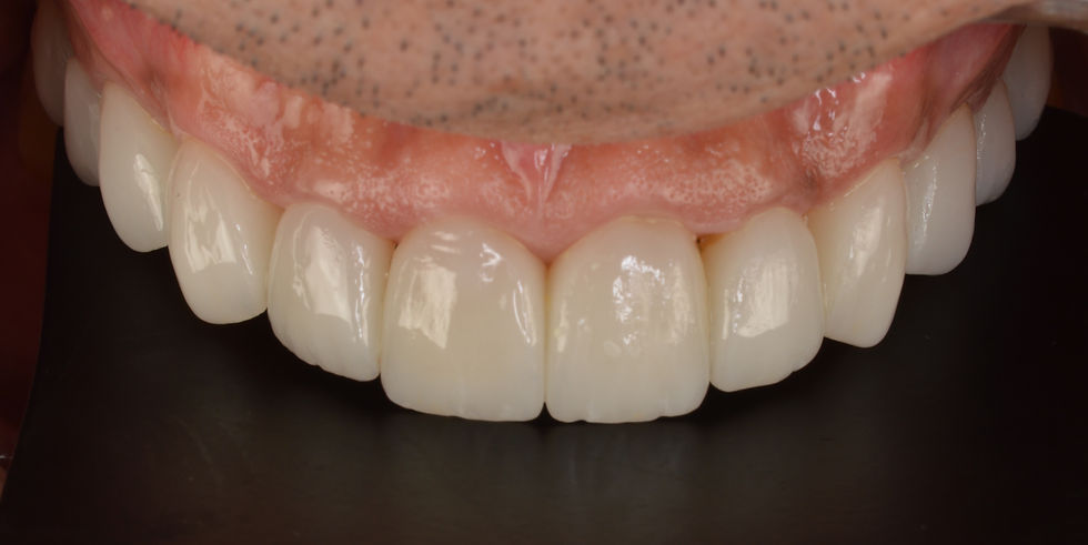 Resultado final de rehabilitación estética en sector anterior mediante carillas feldespáticas, donde se ha conseguido una integración completa entre forma, color y textura dental. El caso ha sido desarrollado mediante flujo digital en laboratorio dental, permitiendo un control preciso de la anatomía y la oclusión. Este tipo de tratamientos son clave en clínicas que buscan resultados predecibles en estética dental avanzada y rehabilitación oral completa, trabajando en coordinación con un laboratorio especializado. Rehabilitación en Clase III con aumento de dimensión vertical: planificación y ejecución desde laboratorio dental con flujo digital para clínicas que realizan casos complejos.