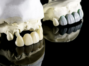 combinar tecnología digital y estratificación manual en restauraciones dentales