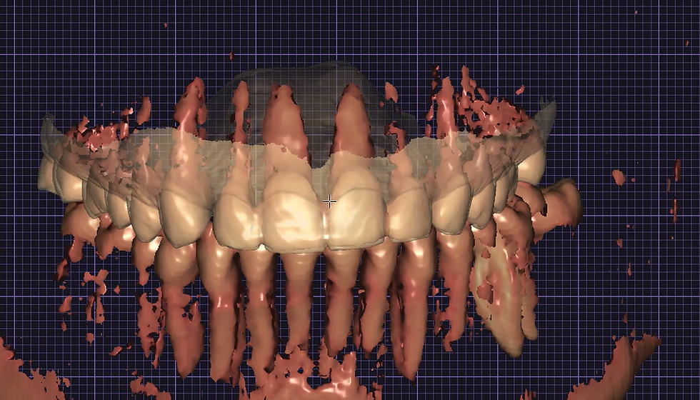 diseño protésico digital en implantología con flujo digital, reconstrucción 3D dental a partir de escaneado intraoral y CBCT, planificación de rehabilitación completa sobre implantes en laboratorio dental digital