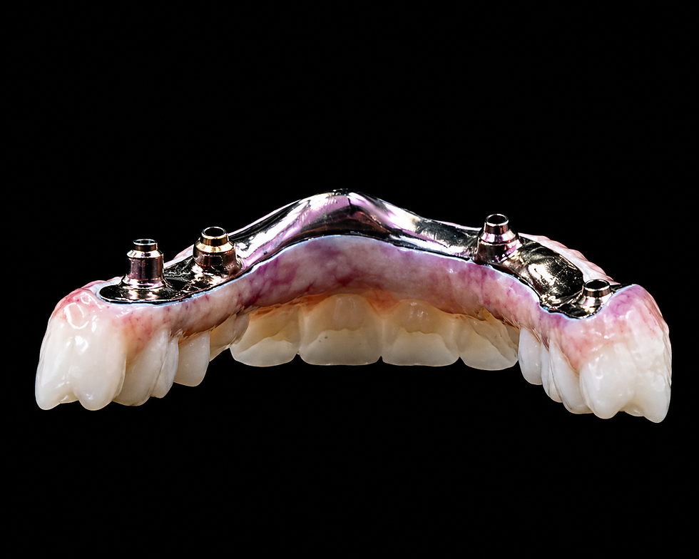 rehabilitación completa sobre implantes en Barcelona