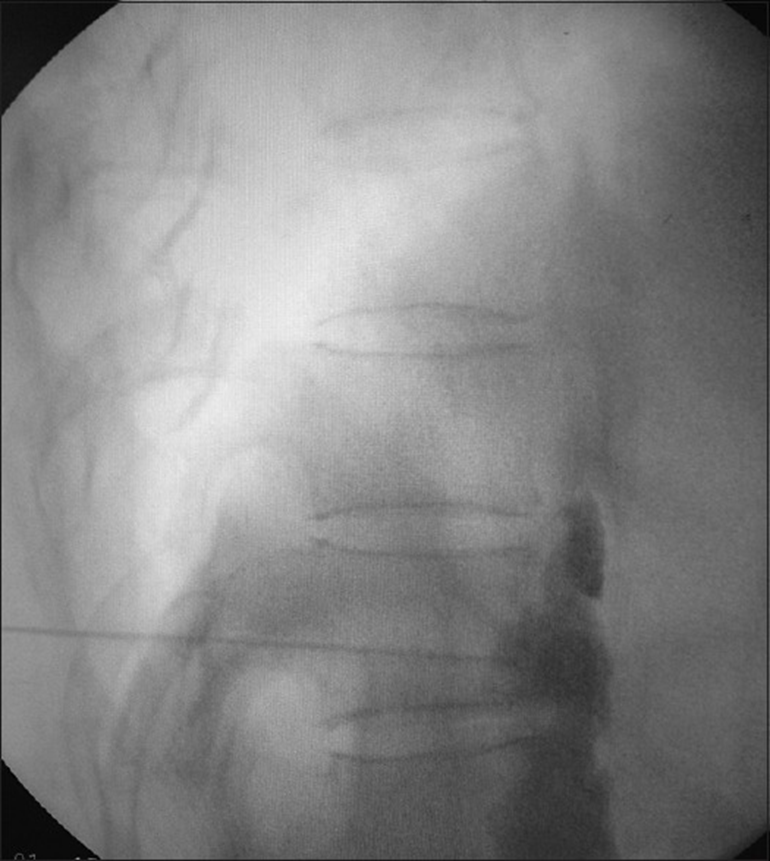 The Lateral view of the contrast spread in the splanchnic nerve block.