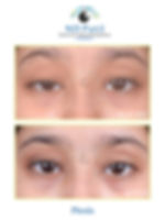 Ptosis.jpg