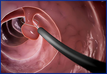 Colorectal Cancer Screening
