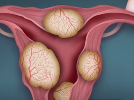 Sonohysterogram