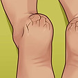Crack in Heels