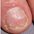 Psoriasis on nails