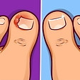 Ingrown toenail
