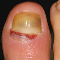 Retronychia