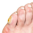 Corn on toe