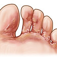 Tinea/Athletes foot