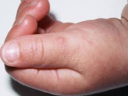 Hand-Fuß-Mund, Hand-Fuß-Mund-Krankheit (HFMD) 