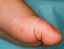 Hand-Fuß-Mund, Hand-Fuß-Mund-Krankheit (HFMD) 