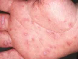 Hand-Fuß-Mund, Hand-Fuß-Mund-Krankheit (HFMD) 