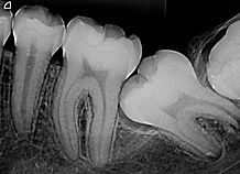 radiografia_periapical-2z0kvyjvvnqmxenmr