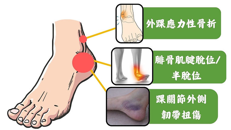 腳踝外側痛原因