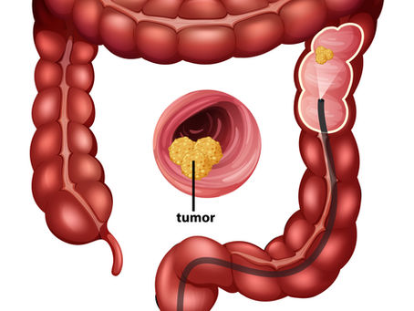 Cáncer de colon: señales de alerta y hábitos que pueden marcar la diferencia