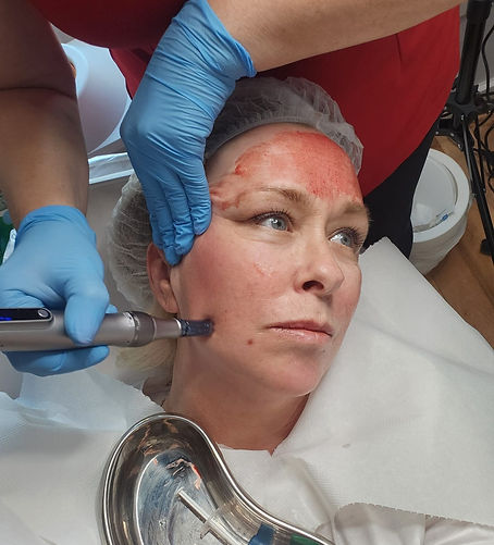 Image of client getting PRP Vampire Facial