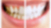 SCALING%20N%20POLISHING_edited.jpg