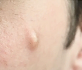 cyst removal surgery