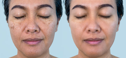 Hello Advanced Skin Resurfacing Lasers, So Long Discoloration! 