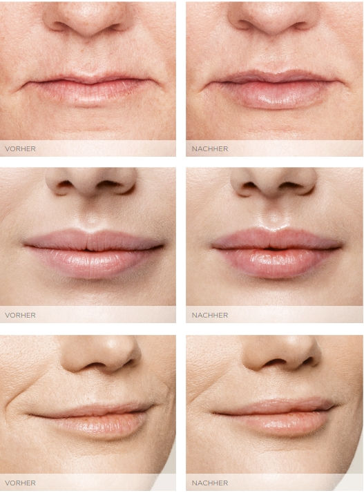 Lippen Vorher-Nachher Bilder.jpg