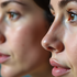 Rinoplastia en Guadalajara: diferencia entre rinoplastia estética y funcional para mejorar tu respiración