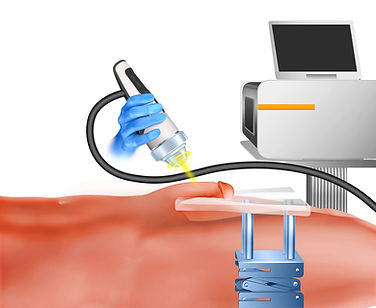 ED Shockwave therapy to improve erections