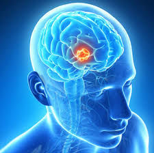 Brain Tumors