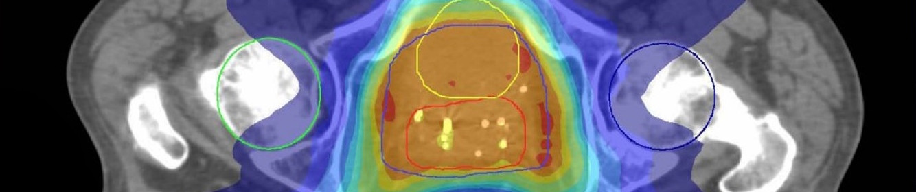 Advanced radiotherapy scan in a modern clinical setting, highlighting state-of-the-art cancer treatment technology.