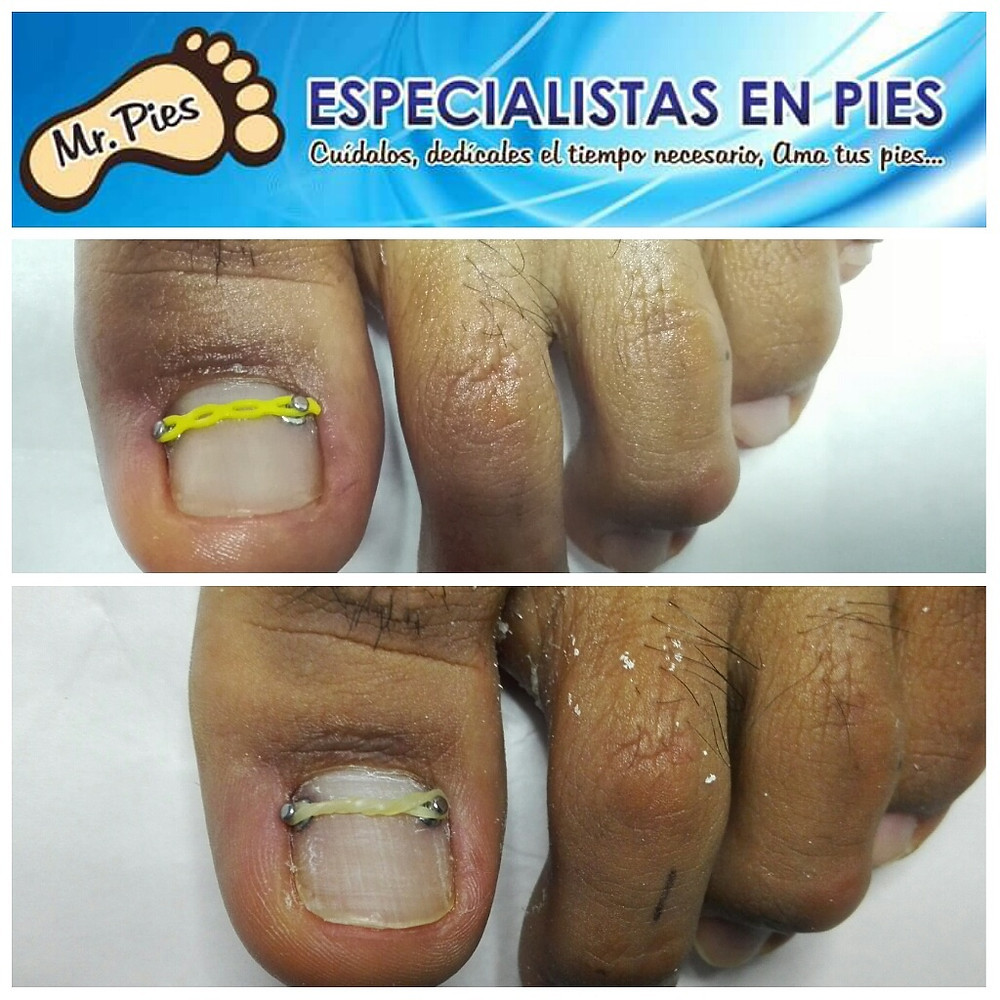 uñas pies ortonixia