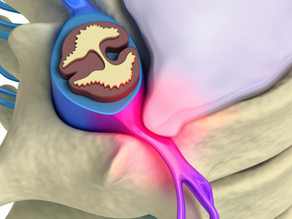 The Pinched Nerve Fix: How Spinal Decompression Can Ease Your Herniated Disc Pain