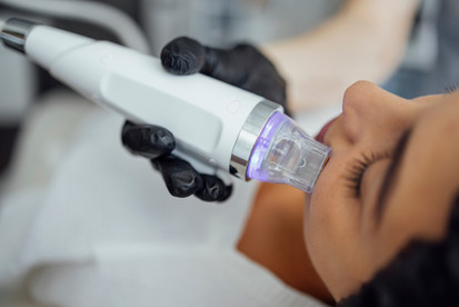 Hand holding an RF microneedling device performing treatment on a person's face.